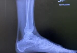 X-Ray Left Foot