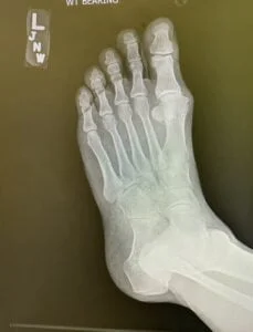 X-Ray Left Foot