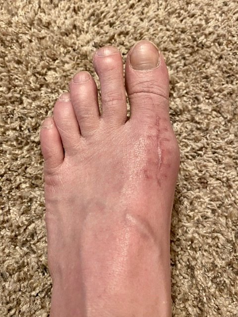 Hallux Limitus – Part 5 – the road to recovery